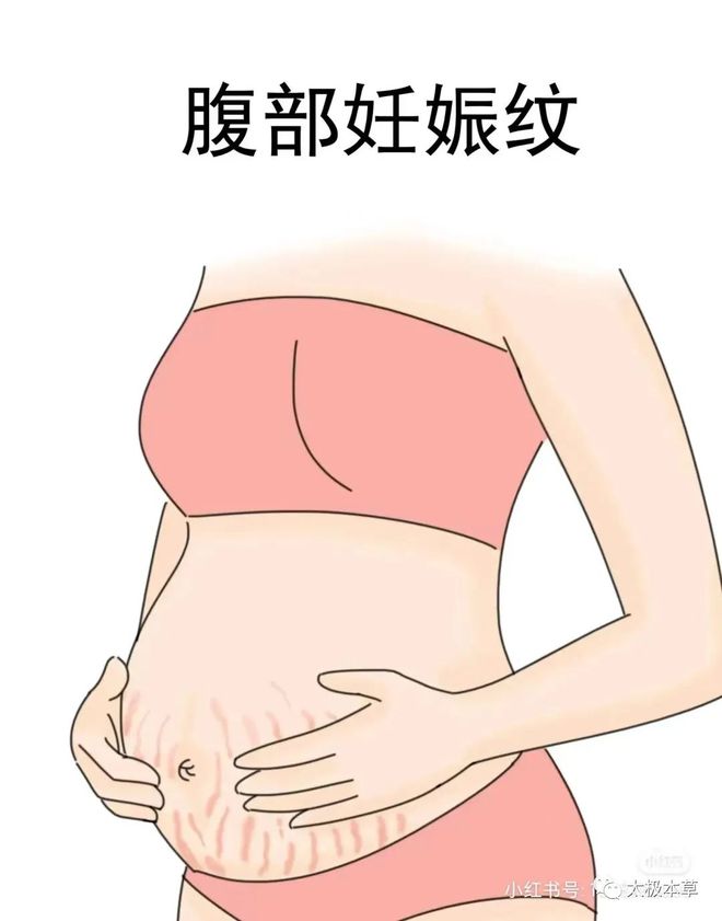 孕期淡化妊娠纹_淡化妊娠纹的原理_淡化妊娠纹妊娠